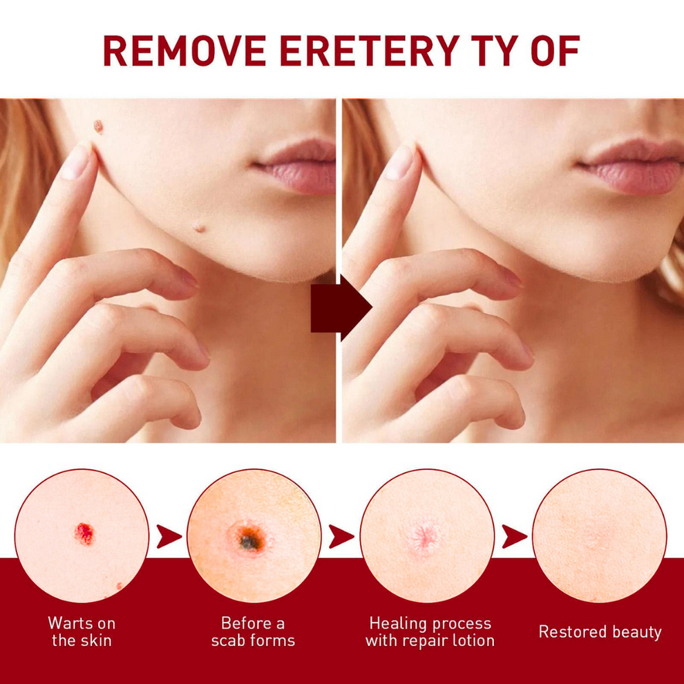 HerbaCare™ Tags & Mole Remover